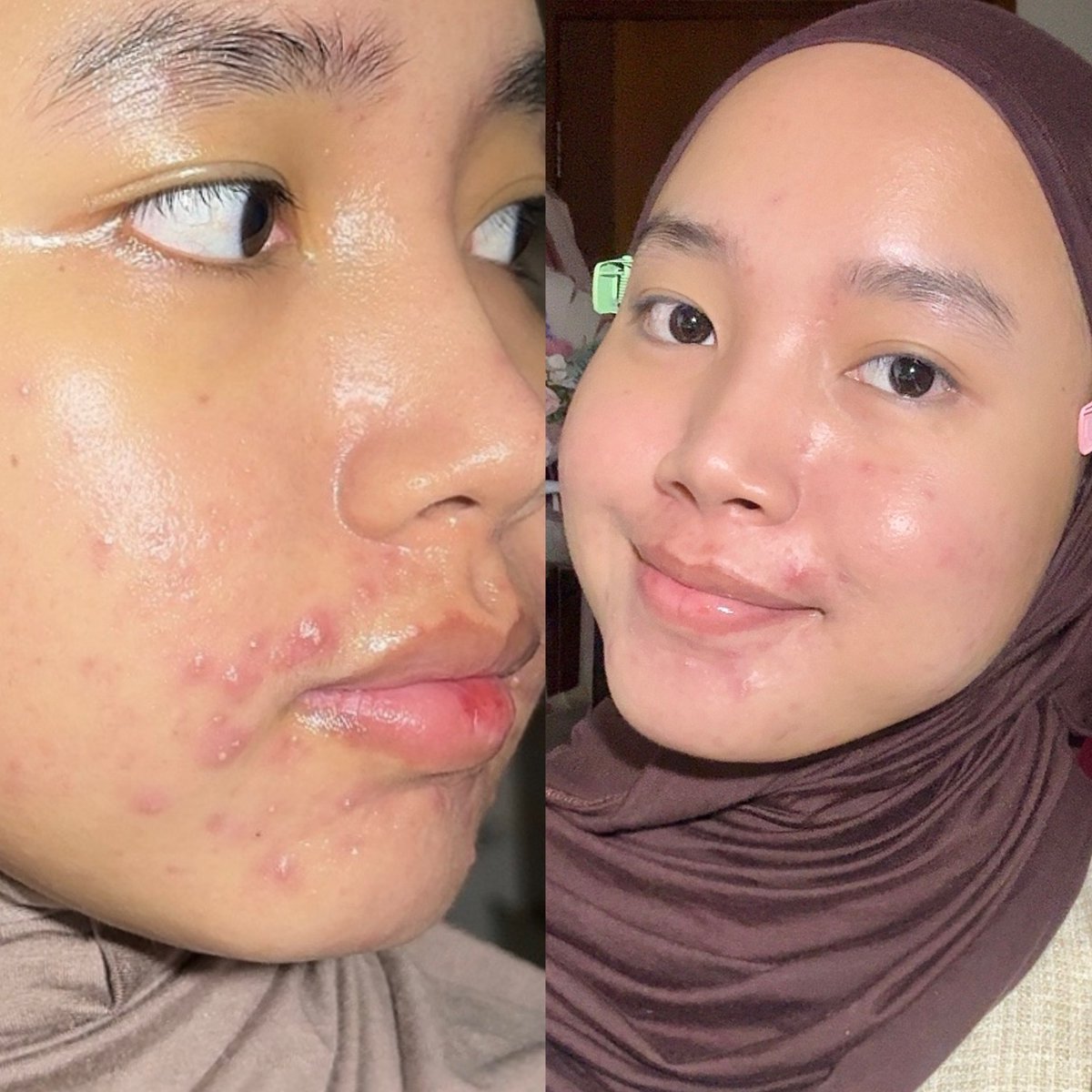 cloudysnowys's tweet photo. ELFORMULA 🤝 HYALUPURE= best 😭👍🏻

jerawatan deket mulut gara2 gacocok sama odol &amp; fokusin pakai 2 ini jadi lumayan better banget &amp; sisa bekasnya. exfo &amp; hydrating adalah koentji...

aku mau share urutan pakai produknya👇🏻 https://t.co/O6DcY6bvkv