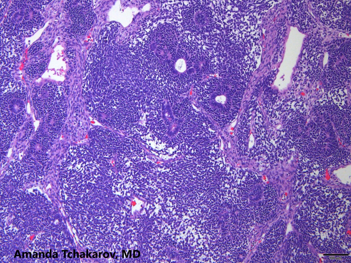 UTHoustonPath's tweet photo. Classic pediatric renal tumor. @ATchakarov1 #PathTwitter #PediPath #GUpath #PathX #pathresidents https://t.co/b5CwfUTw96