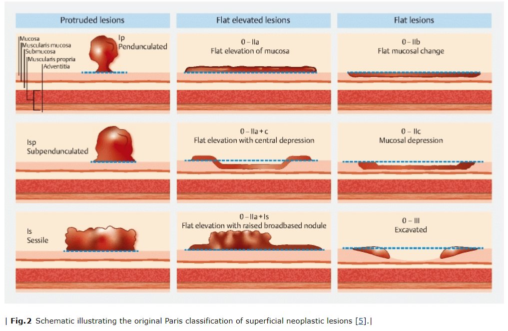 SEED (@seedendoscopia) on Twitter photo 🔵 Actualización de la guía europea sobre resección endoscópica y polipectomía colorrectal.
Puesta al día con la participación española de <a href="/VicenteLorenz19/">Vicente Lorenzo-Zúñiga García</a>, <a href="/mariapellise1/">mariapellise</a>, <a href="/edalbeniz/">Eduardo AA</a> y <a href="/Rodrigus01/">rodrigo jover</a>. <a href="/ESGE_news/">ESGE</a>
¡Encuéntrala en <a href="/endoscopyjrnl/">Endoscopy Journal</a>! 👉 thieme-connect.de/products/ejour… 🔵 Actualización de la guía europea sobre resección endoscópica y polipectomía colorrectal.
Puesta al día con la participación española de <a href="/VicenteLorenz19/">Vicente Lorenzo-Zúñiga García</a>, <a href="/mariapellise1/">mariapellise</a>, <a href="/edalbeniz/">Eduardo AA</a> y <a href="/Rodrigus01/">rodrigo jover</a>. <a href="/ESGE_news/">ESGE</a>
¡Encuéntrala en <a href="/endoscopyjrnl/">Endoscopy Journal</a>! 👉 thieme-connect.de/products/ejour…