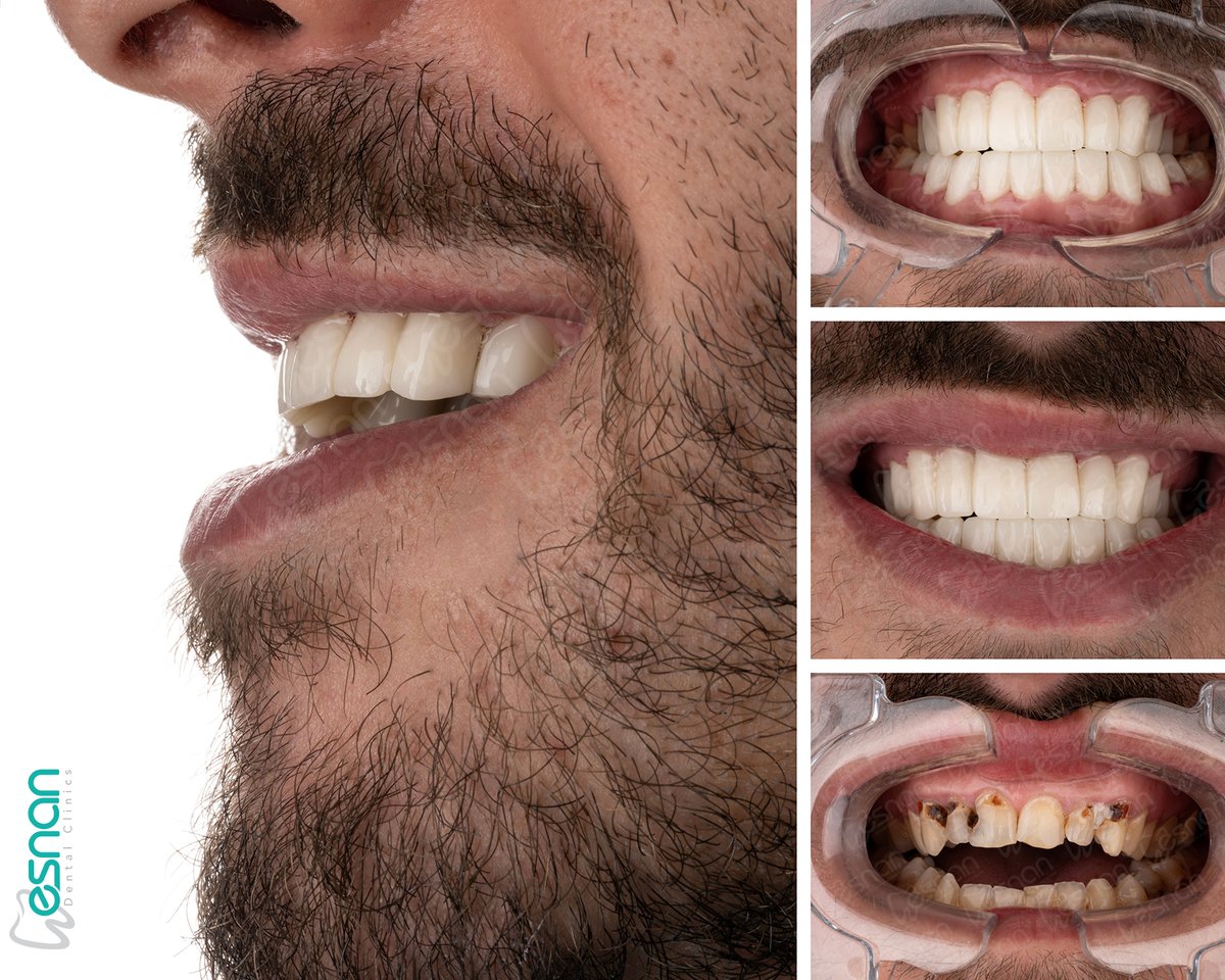 esnanclinics's tweet image. Say goodbye to open bite problems! At Esnan Dental Clinics, we offer high-standard treatment options. 

Learn more: esnandentalclinics.com 

#openBite #Dental #ortodontics