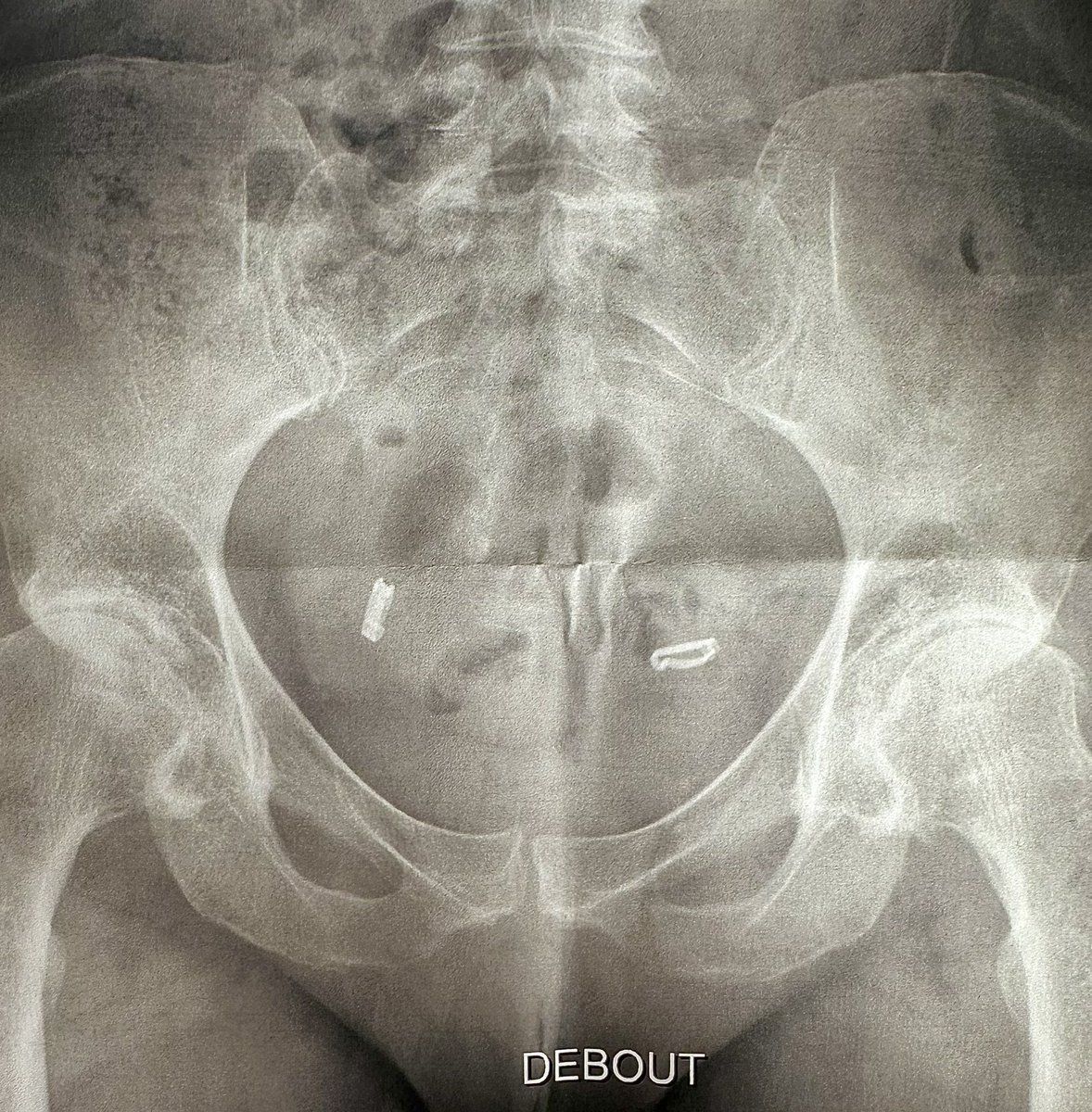 DrWEI_EU's tweet image. #postoperation patient receiving #treatment from #acupuncture #acupressure #lyimpact .