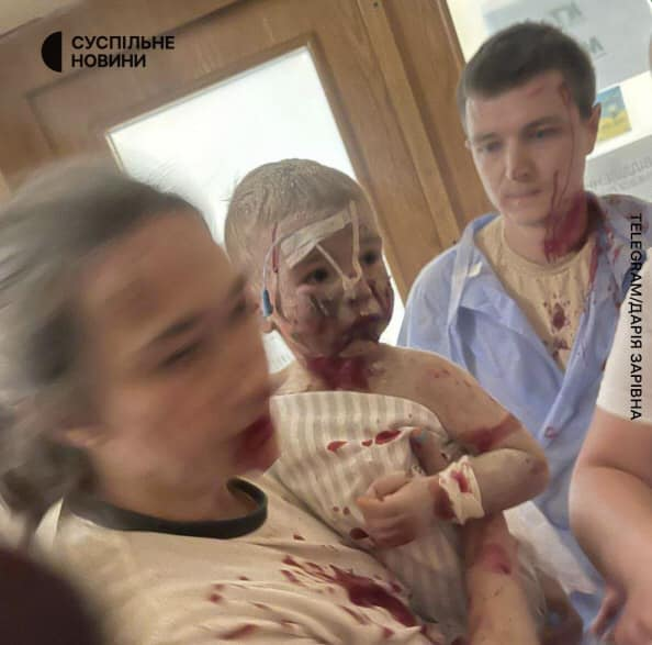 Mr_Loki_Jr's tweet photo. An injured child as a result of today’s attack on the “Okhmatdyt” Children’s Hospital in Kyiv - 07/08/2024. The country of barbarians and murderers - russia - continues to terrorize the civilian population of the sovereign state of Ukraine. 
#russiaisaterroriststate https://t.co/eVQb1mqzwH