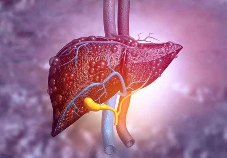 SAGES &amp; ASTS

Consider #BariatricSurgery  prior to Liver Transplant if:

🔺BMI&gt;35 
🔺MELD&lt; 15
🔺Platelet&gt;50 
🔺INR&lt;2.5
🔺Albumin&gt;2.5
🔺No or minimal ascites 
🔺No or mild encephalopathy
🔺Nothing more than small esophageal varices

link.springer.com/article/10.100…

amjtransplant.org/article/S1600-…