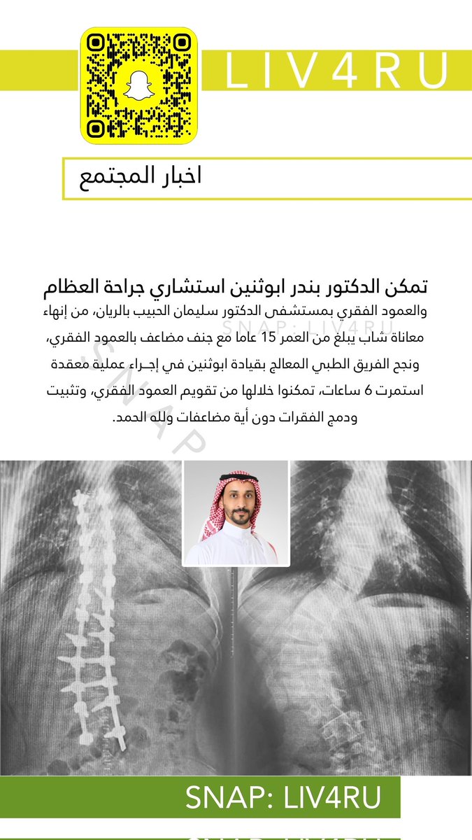 تمكن الدكتور بندر ابوثنين استشاري جراحة العظام والعمود الفقري بمستشفى سليمان الحبيب بالريان من إنهاء معاناة شاب يبلغ من العمر 15 مع جنف مضاعف بالعمود الفقري ونجح الفريق الطبي المعالج بقيادة ابوثنين في إجراء عملية معقدة استمرت 6 ساعات تمكنوا خلالها من تقويم العمود الفقري وتثبيته