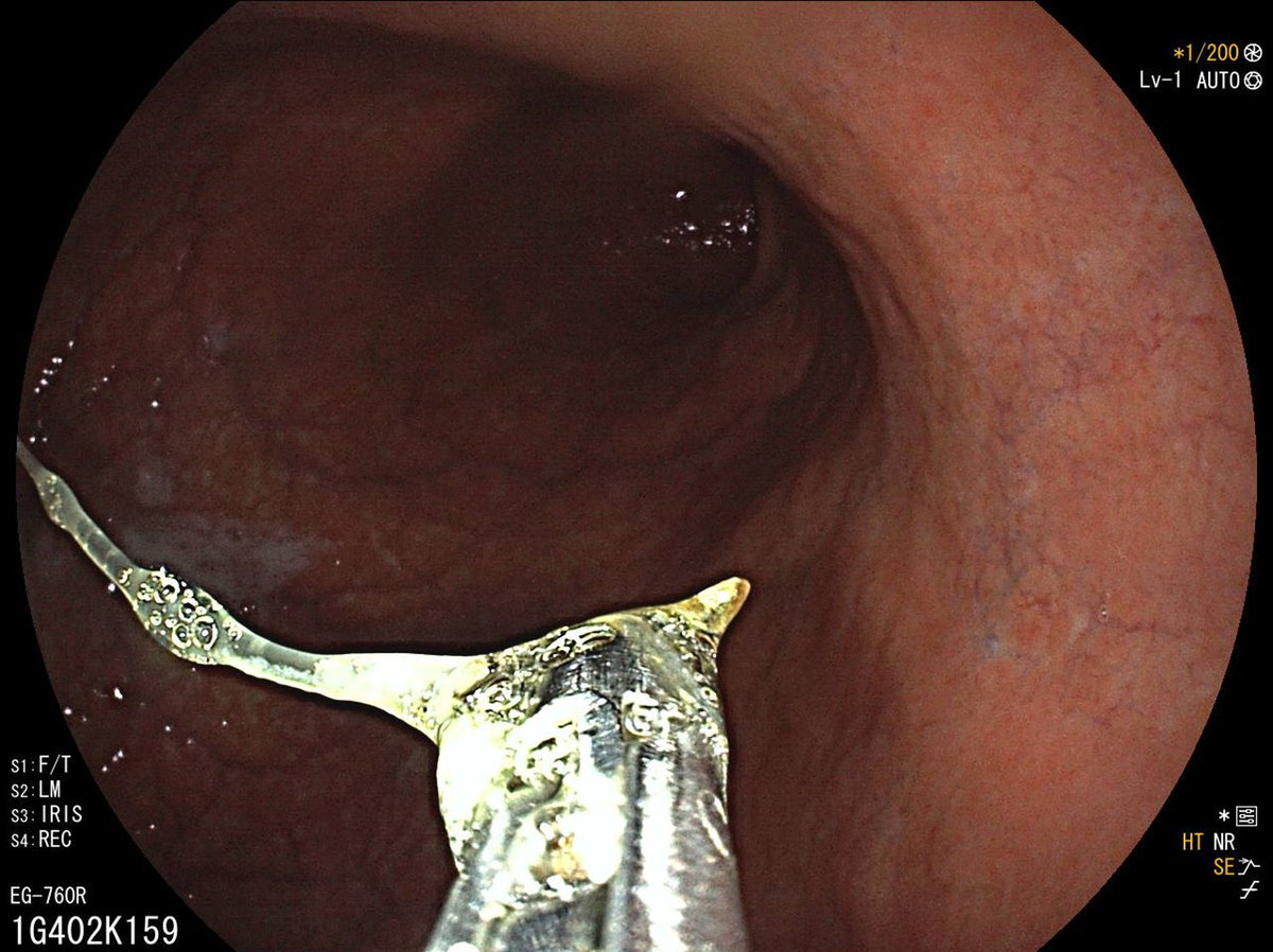 LumirKunovsky's tweet photo. Unusual #Biliary #Complication following #Christmas Eve Dinner 🎄🐟 🎁
✅️Fish🦴 bone impacted in major papilla resulting in dyspepsia and mild elevation in #liver function tests,which was treated #endoscopically
📗 @GastroKarger
👉https://t.co/447asyjeyQ
@ESGE_news @my_ueg https://t.co/7PN1GbgsLq