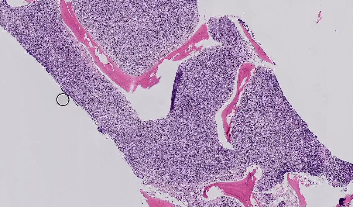 Tiger_heme's tweet image. BMB 41 yo male. All these cells are positive for CD3, CD5, CD2, CD7. In the pics you can see the CD4 and CD8. What is your diagnosis? What other stains would you like to see?
