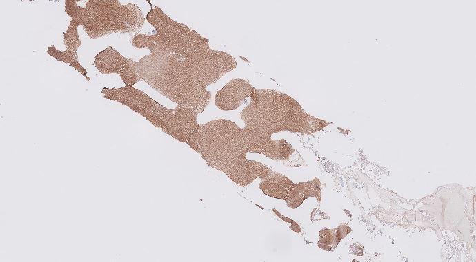 Tiger_heme's tweet image. BMB 41 yo male. All these cells are positive for CD3, CD5, CD2, CD7. In the pics you can see the CD4 and CD8. What is your diagnosis? What other stains would you like to see?