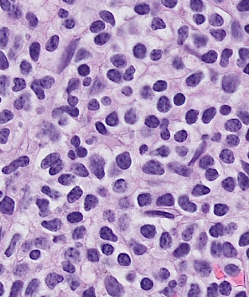 Tiger_heme's tweet image. BMB 41 yo male. All these cells are positive for CD3, CD5, CD2, CD7. In the pics you can see the CD4 and CD8. What is your diagnosis? What other stains would you like to see?