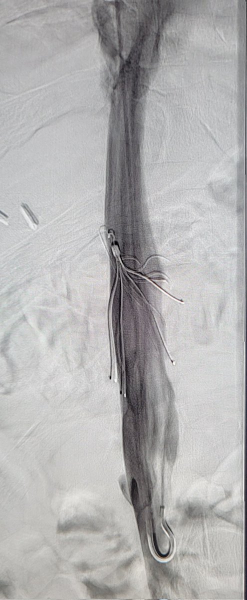 TempleRADs's tweet photo. Patient with IVC filter with arm and leg protrusion and thrombus. Thrombectomy performed with Penumbra with clearance of clot.  Filter removed with endobronchial forceps. Extra effort required, but job well done Dr. Niman and Dr. Holten! @TempleRadRes @SIRRFS @SIR_ECS #filterout https://t.co/YxjbnqUUqC
