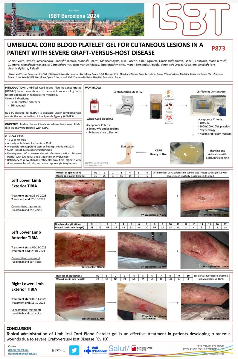 marinarc77's tweet photo. Check out our poster about umbilical cord blood platelet gel to treat severe cutaneous wounds. Results are astonishing! #ISBT2024 #ISBTBarcelona @BSTVH_ Thanks to Dinara Samarkanova from the BST-Cell Therapy Unit and our study nurse's team, specially @DavidGomezVives https://t.co/dFgSJrkHG7