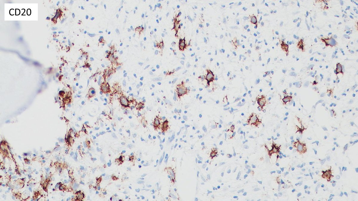 javidiparsijani's tweet photo. A great case of #THRLBCL (Tcell/histiocyte rich large B cell lymphoma in #BM with marked resemblance to #Hogdgkin lymphoma (#RS - like cells). The cells are CD30, CD15 and mum-1 (-) and are (+) for CD20, BCL-6, pax5. EBER-ISH is neg.
#largeBcelllymphoma
#bonemarrow https://t.co/JxNZomEqNX