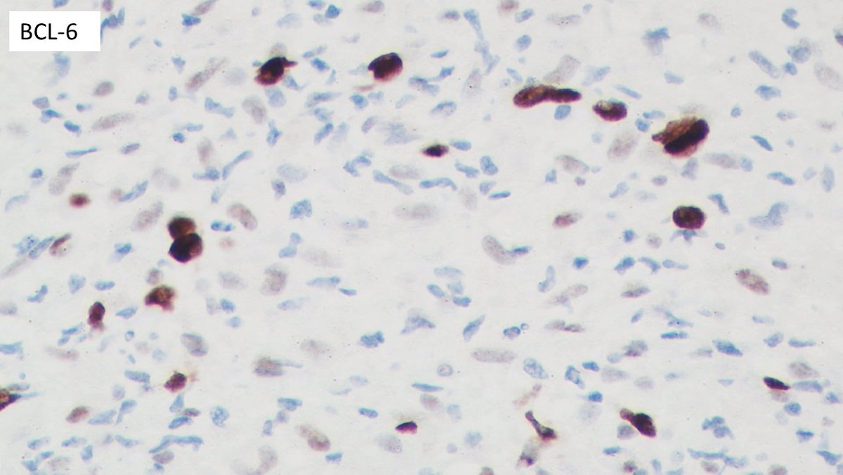 javidiparsijani's tweet photo. A great case of #THRLBCL (Tcell/histiocyte rich large B cell lymphoma in #BM with marked resemblance to #Hogdgkin lymphoma (#RS - like cells). The cells are CD30, CD15 and mum-1 (-) and are (+) for CD20, BCL-6, pax5. EBER-ISH is neg.
#largeBcelllymphoma
#bonemarrow https://t.co/JxNZomEqNX