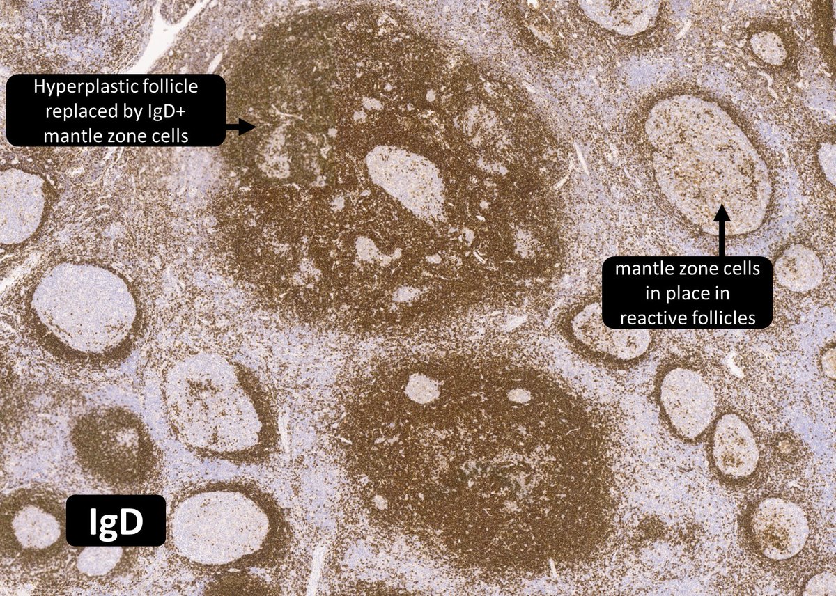 DrCycloPath's tweet photo. In progressive transformation of germinal centers, infiltrating mantle cells express
a) SOX11
b) cyclin D1
c) CD20
d) BCL6
#HemePath #PathTwitter #Pathology https://t.co/OQXs9iRdj6