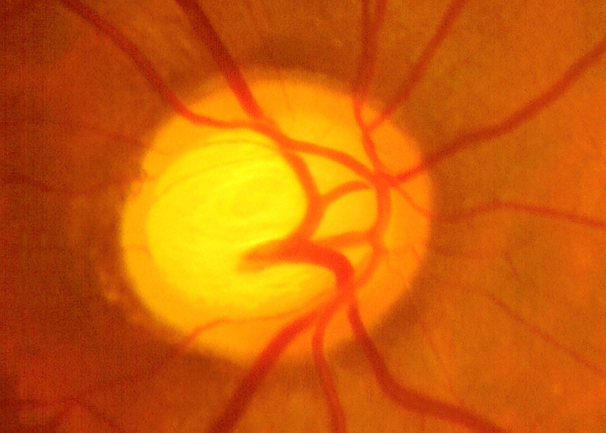 ophth_advisor's tweet image. The #Xen45GelStentImplant provides effective, long-term treatment for #OpenAngleGlaucoma but there is a substantial rate of reoperation and needling. Research in @BMJ_Ophth

Read here: brnw.ch/21wKYH8

#Glaucoma #CataractSurgery #Ophthalmology #EyeHealth
