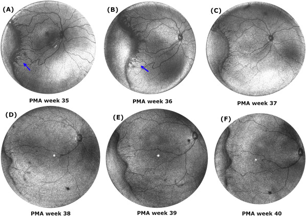 Ophthalmology (@aaojournal) on Twitter photo Infants with #retinopathyofprematurity who had isolated retinal neovascularization, aka “popcorn neovascularization,” were at higher risk of retinopathy of prematurity progression. <a href="/jpetercampbell/">jpetercampbell</a> <a href="/CaseyEye/">OHSU Casey Eye</a> <a href="/jian_yifan/">Yifan Jian</a> @rpb_org ow.ly/ksqM50RMZAR Infants with #retinopathyofprematurity who had isolated retinal neovascularization, aka “popcorn neovascularization,” were at higher risk of retinopathy of prematurity progression. <a href="/jpetercampbell/">jpetercampbell</a> <a href="/CaseyEye/">OHSU Casey Eye</a> <a href="/jian_yifan/">Yifan Jian</a> @rpb_org ow.ly/ksqM50RMZAR