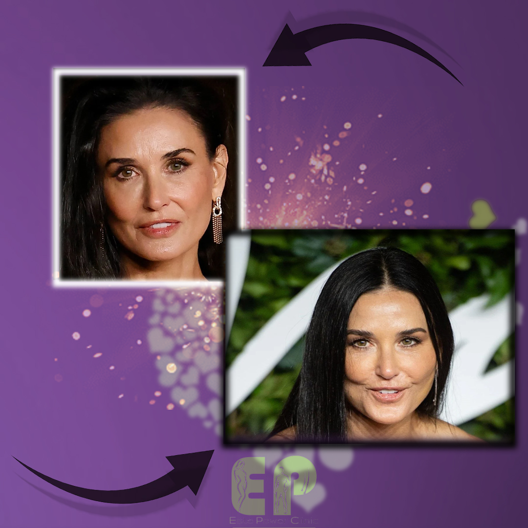❗Demi Moore'nin geçirdiği estetik operasyonları inceledik ve geçirdiği tahmin edilen bazı estetik operasyonları
aşağıdaki ekte sizlerle paylaşıyoruz:

1.  KAŞ KALDIRMA
2. ''BOTOKS-BLEFEROPLASTİ-DOLGU''

#estepower