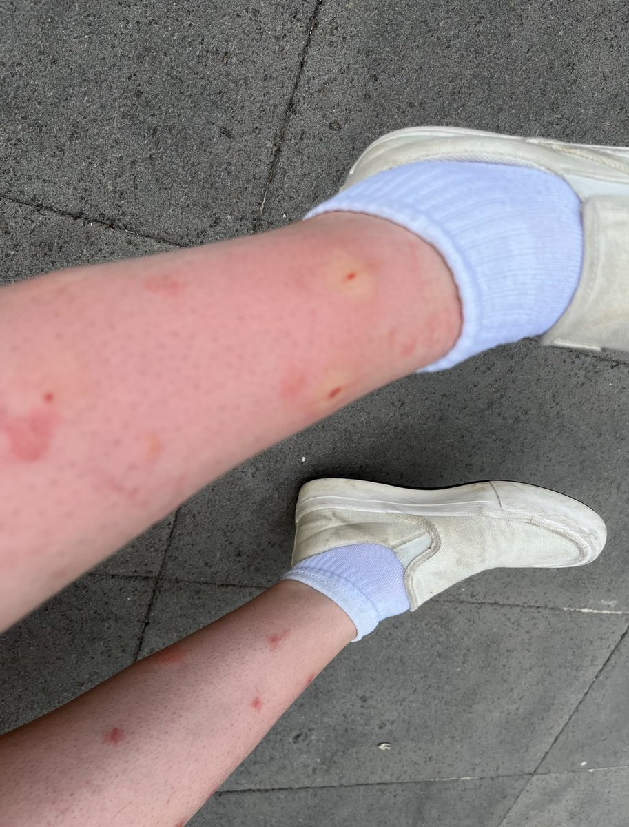 VegolasZer's tweet image. Venez on fait une trend : victimes des moustiques 🥸

J’ai un gros dossier encore sous la main !