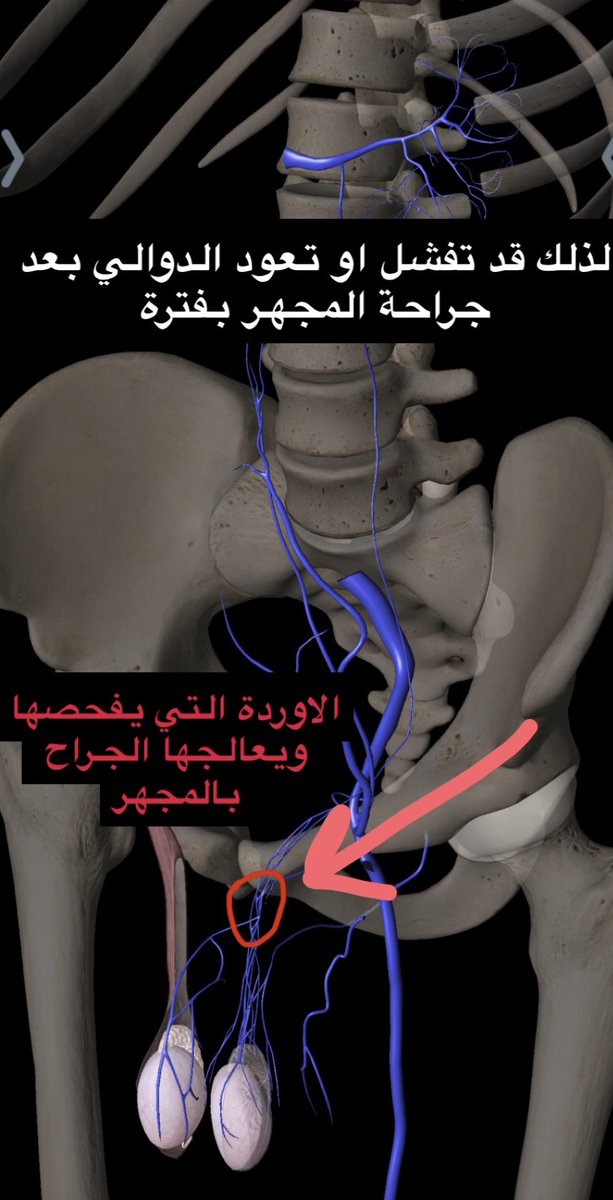 ثريد (أمان الصبغة)
نكمل فيه تصحيح المغالطات التي ينشرها قلة قليلة جداً (٢-٣ فقط دون غيرهم) من بعض أطباء العقم وتوضيح ما يمكن ان يراه طبيب الأشعة التداخلية لعلاج الدوالي ومحدودية ما يمكن للجراح ان يرى: