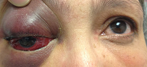 Residents! When it comes to an eye emergency, taking immediate action is essential. Familiarize yourself with these 12 presentations to preserve vision — quickly! #YOInfo ow.ly/ynIY50SpZre
