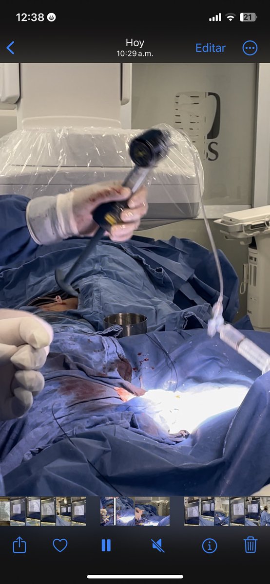We performed the first baloon angioplasty for the relief of central vein stenosis on IMSS UMAE HE 14 Veracruz