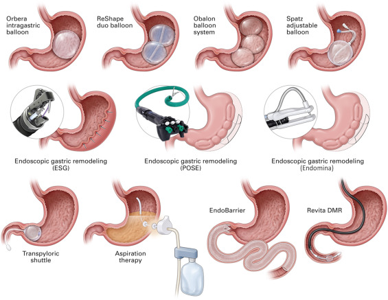 Editor's Choice: Jirapinyo et al present the "ASGE–European Society of Gastrointestinal Endoscopy guideline on primary endoscopic bariatric and metabolic therapies for adults with obesity." giejournal.org/article/S0016-…

<a href="/SighPichamol/">Pichamol Jirapinyo, MD, MPH</a> 

<a href="/DarylRamai/">Daryl Ramai, MD, MPH, MSc.</a>