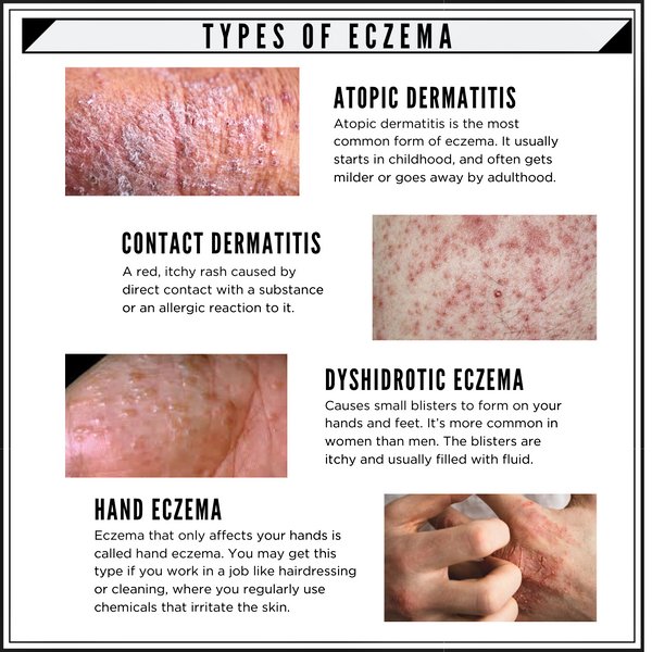 🍁Types of Eczema🍁

#medx
#medEd