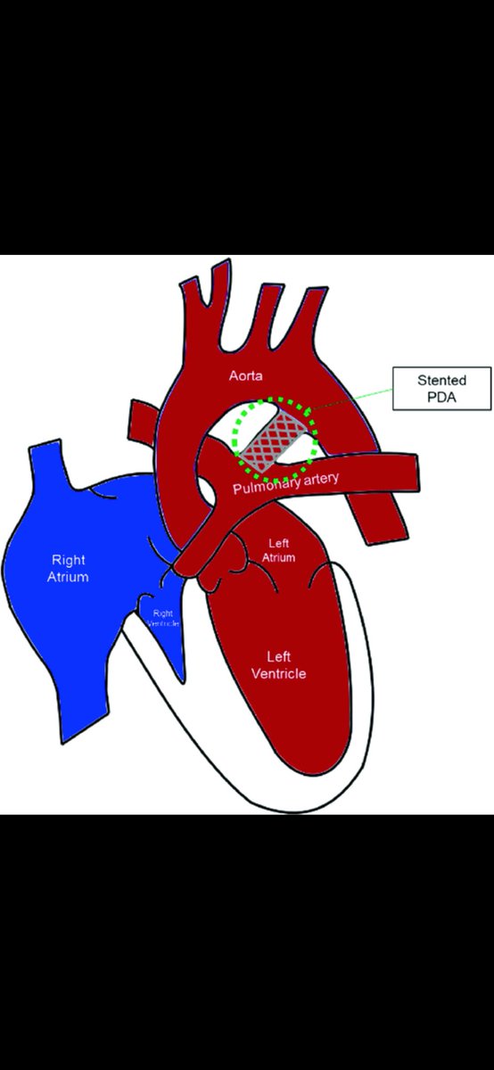 Wayne J. Franklin MD (@drwaynefranklin) on Twitter photo Big congrats to @childrensnational cardiac #intensivist, Dr. Bao “Robyn” Puente, for her first author publication on Ductal Stents vs. Surgical Shunts for Pulmonary Atresia in #pediatriccardiology 📊🩺🫀🔬
. <a href="/pc4quality/">PC4 Pediatric Cardiac Critical Care Consortium</a> <a href="/ACCinTouch/">American College of Cardiology</a> <a href="/CardiacUnited/">Cardiac Networks United</a>
#pcics #cardiology #icu #cicu Big congrats to @childrensnational cardiac #intensivist, Dr. Bao “Robyn” Puente, for her first author publication on Ductal Stents vs. Surgical Shunts for Pulmonary Atresia in #pediatriccardiology 📊🩺🫀🔬
. <a href="/pc4quality/">PC4 Pediatric Cardiac Critical Care Consortium</a> <a href="/ACCinTouch/">American College of Cardiology</a> <a href="/CardiacUnited/">Cardiac Networks United</a>
#pcics #cardiology #icu #cicu