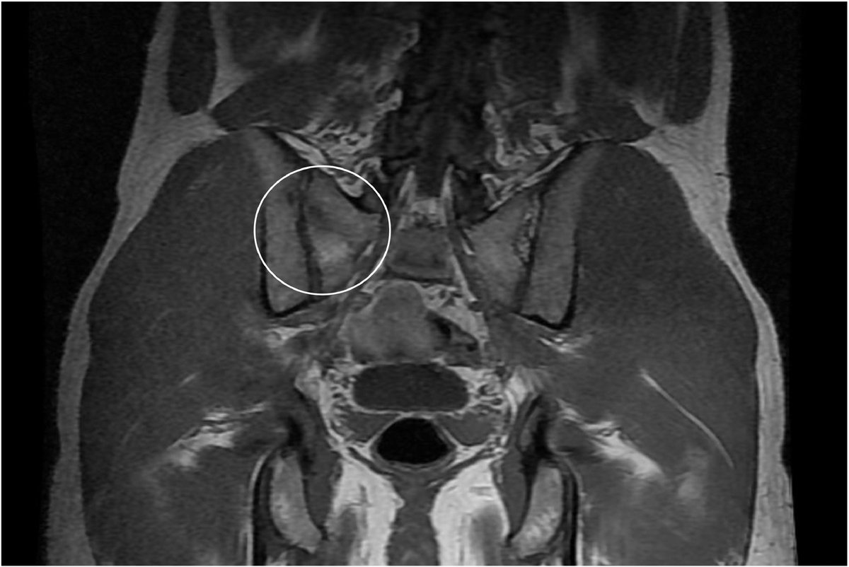 Sacral stress fracture, a case report. apunts.org/es-sacral-stre…