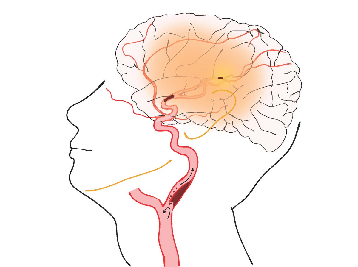 Stroke AHA/ASA (@strokeaha_asa) on Twitter photo 🧵 #STROKE July Cover Figure: "Cervical Dissection in Patients With Tandem Lesions Is Associated With Distal Embolism and Lower Recanalization Success" by <a href="/mili_galecio/">Milagros Galecio-Castillo, MD</a> et al. #AHAJournals 🧵 #STROKE July Cover Figure: "Cervical Dissection in Patients With Tandem Lesions Is Associated With Distal Embolism and Lower Recanalization Success" by <a href="/mili_galecio/">Milagros Galecio-Castillo, MD</a> et al. #AHAJournals