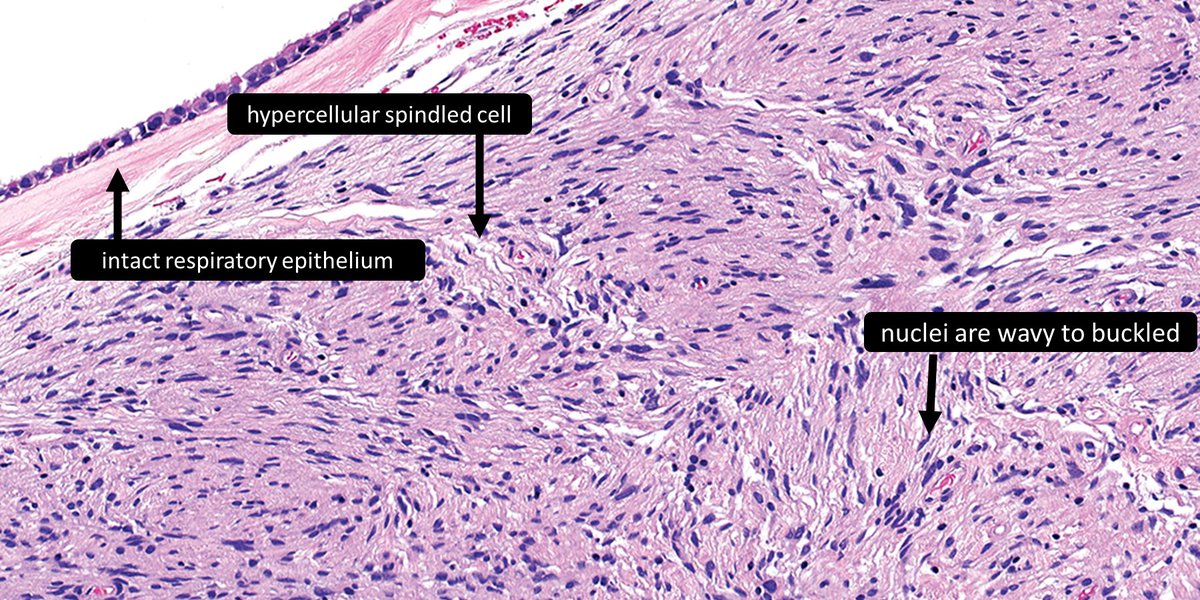 DrCycloPath's tweet photo. Sinonasal ______
a) meningioma
b) schwannoma
c) neurofibroma
🔬https://t.co/6exze2XQoA
#ENTPath #BSTPath #PathTwitter #DermPath #Pathology https://t.co/AZui7qranh