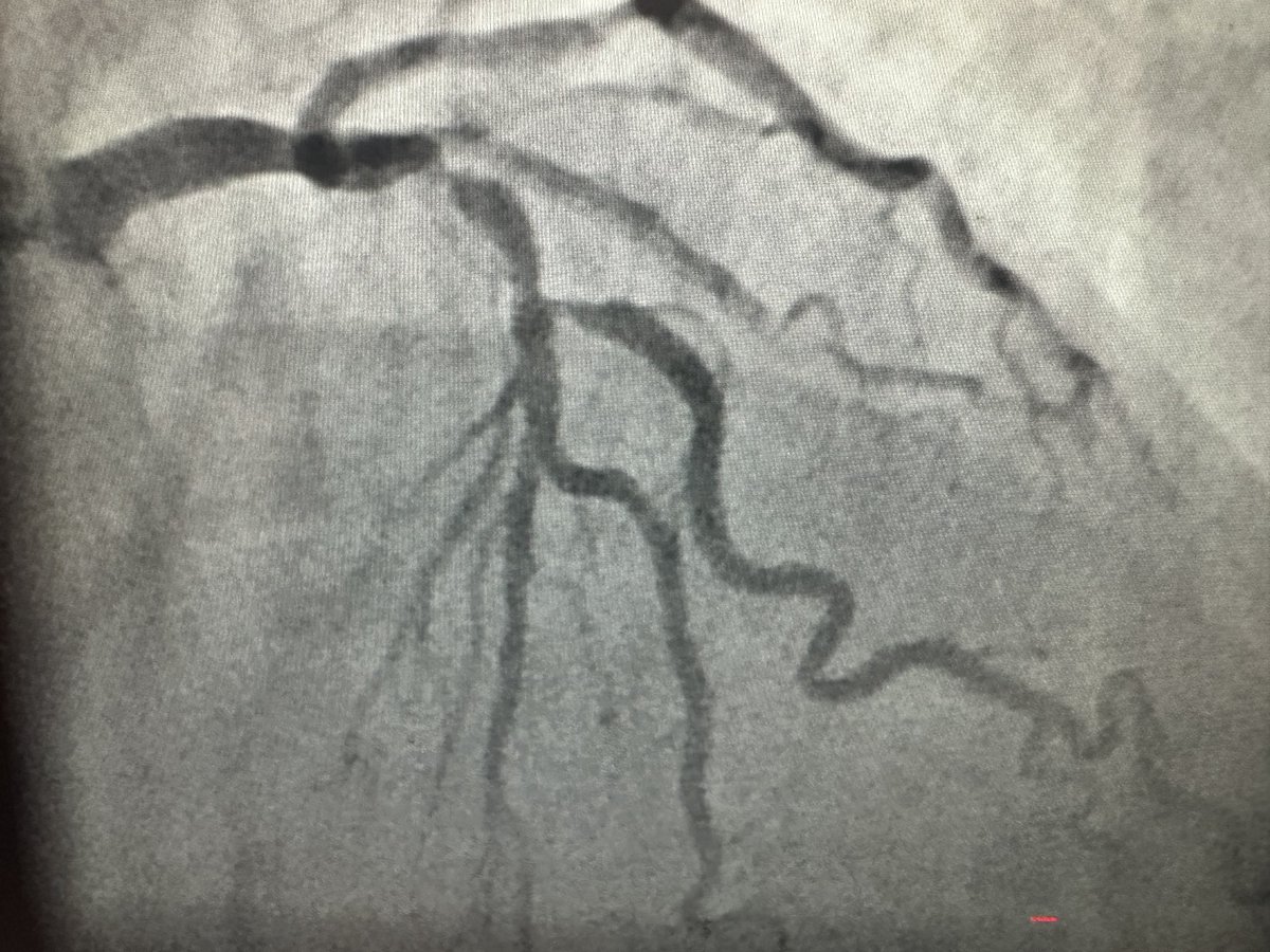 Aslanger EKG pattern.