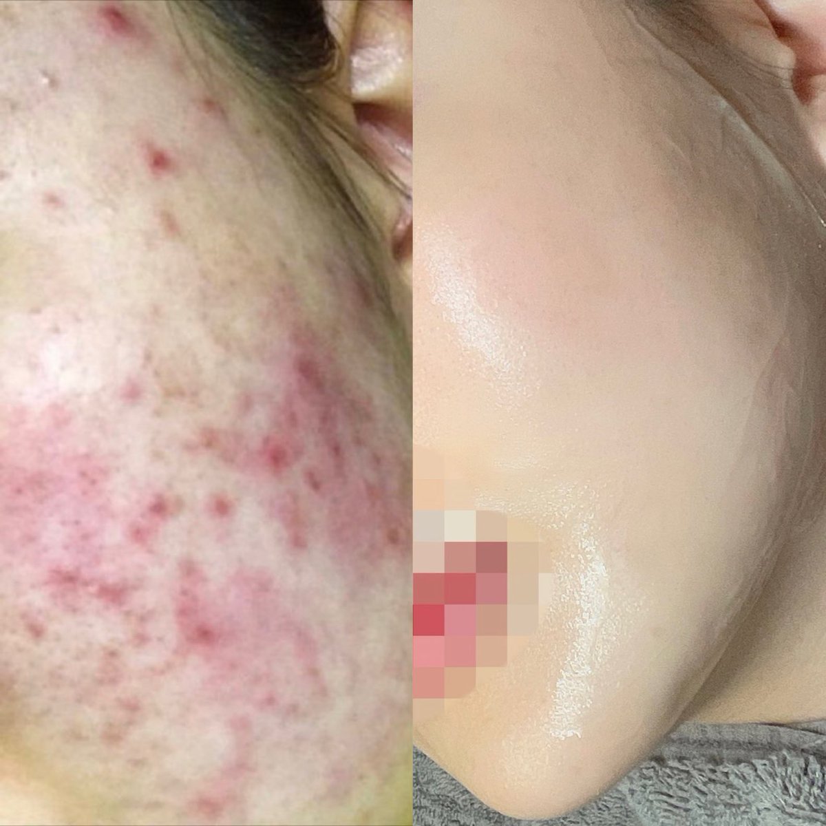 suni__fit's tweet image. 早9年数えきれないくらい肌管理を受けてきた私の肌管理痛みレベル速見表（個人的見解です）