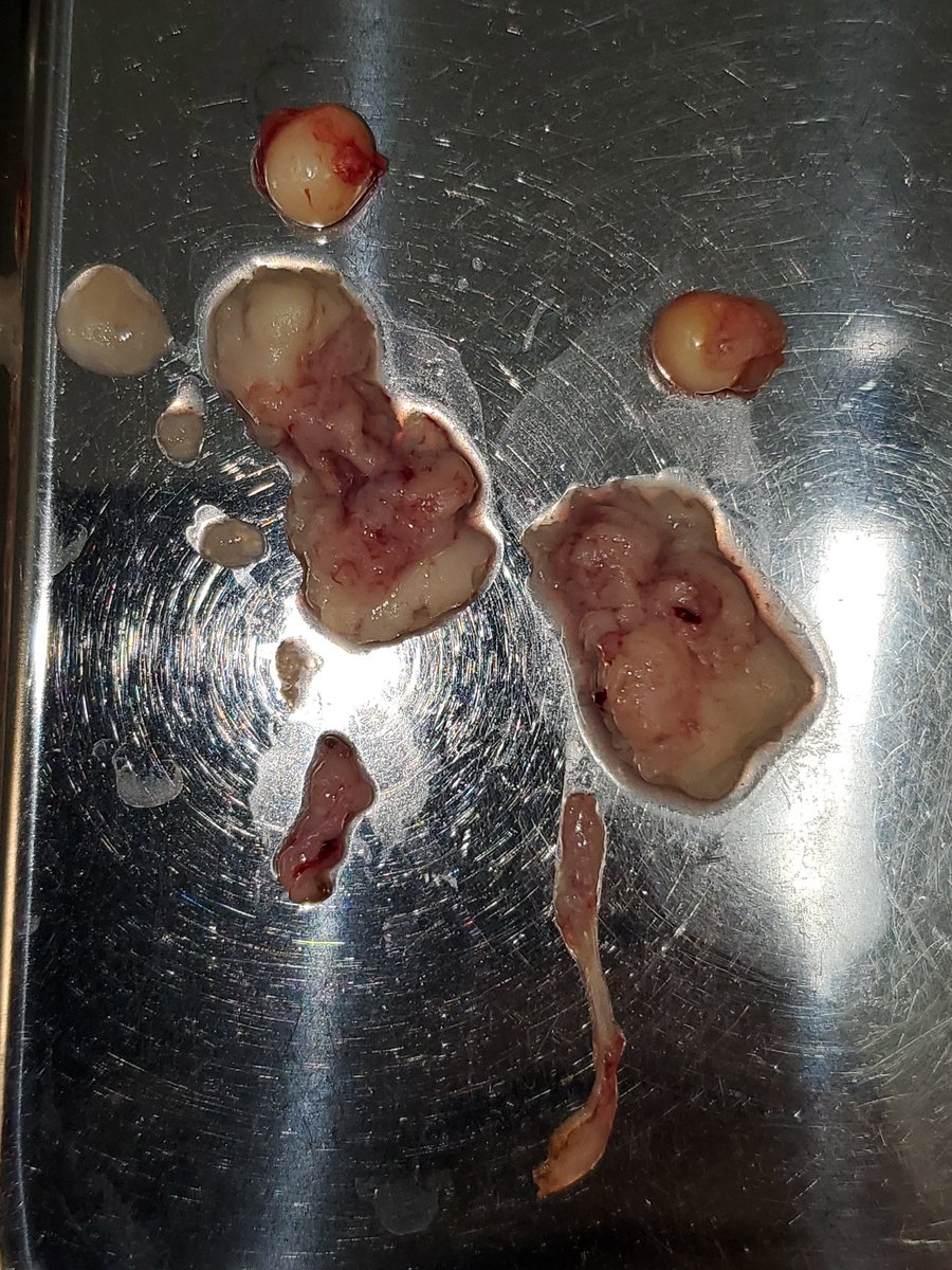 oosakasakaiah's tweet photo. ヒョウモントカゲモドキの卵詰まりでは時に破裂することがあります
特にお腹が膨らんでから1ヶ月以上経っているというような慢性経過症例では破裂して体腔炎を発症していることがあります
おかしいと思ったら早めに動物病院へ連れて行ってあげてくださいね

#ヒョウモントカゲモドキ
#卵墜性体腔炎 https://t.co/wiJOKpRSWh