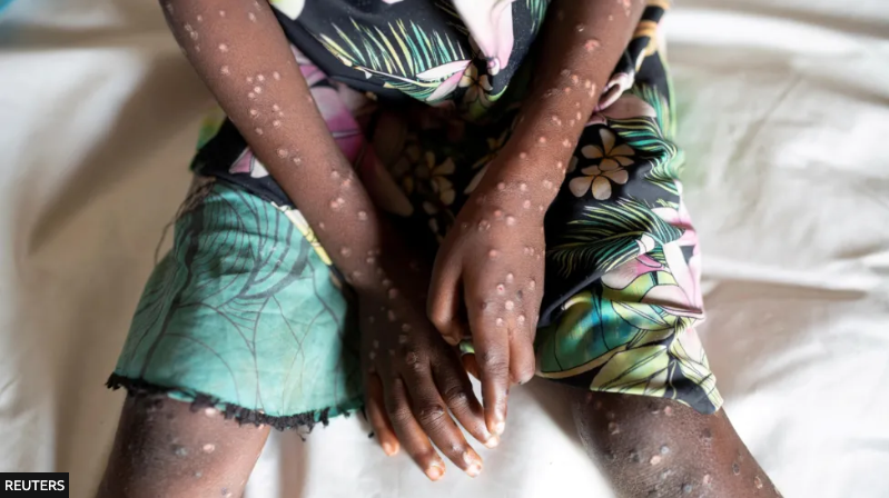 BBCAfrica's tweet image. What is mpox and how is it spread?

A new strain of the mpox virus is spreading quickly in the Democratic Republic of Congo, and experts say it is the most dangerous variant they have seen.

Find out more: bbc.in/3L23jnh