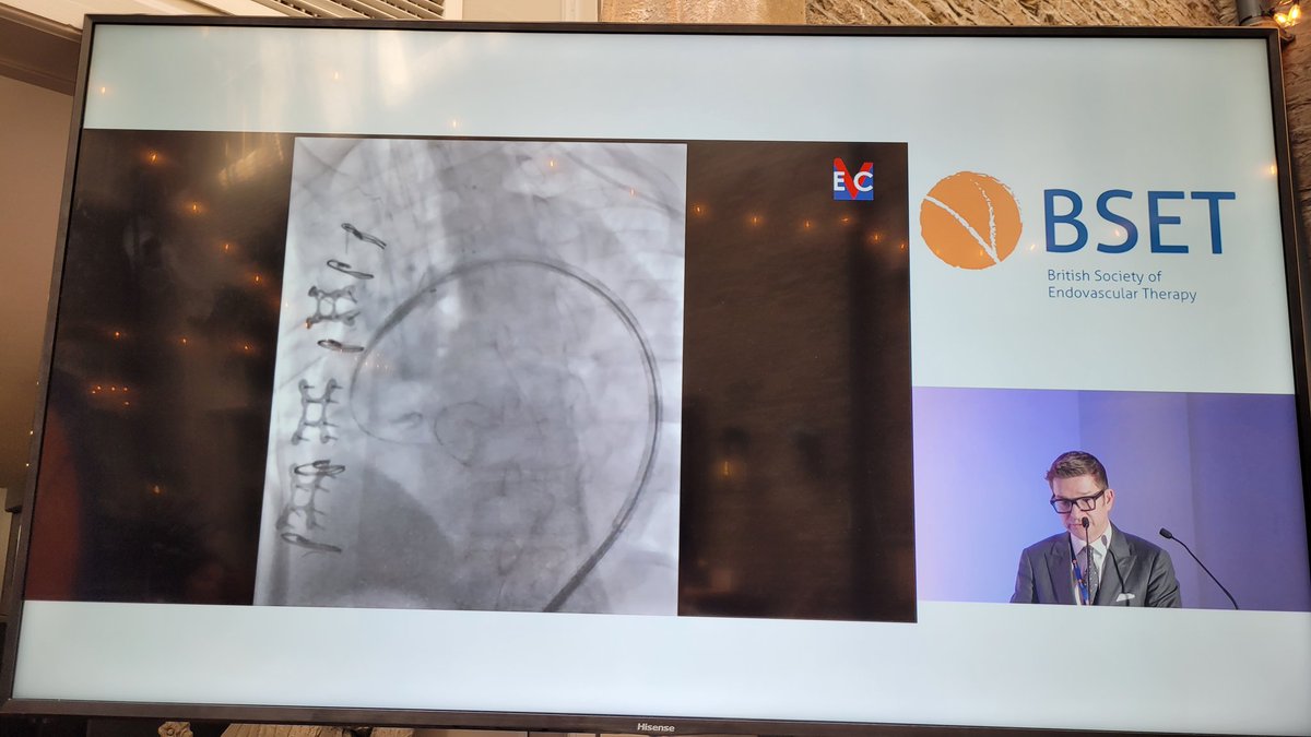 Thank you to our distinguished speakers for their case presentations Barend Mees <a href="/GustavoOderich/">Gustavo Oderich</a> Ash Patel
#BSET2024