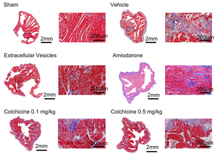 davis_ctrl's tweet image. Pericarditis increases atrial scar tissue. While anti-inflammatories offer modest reduction and antiarrhythmics have no effect on fibrosis, a single EV injection eliminates fibrosis and atrial fibrillation! doi:10.1016/j.jacep.2024.02.019 #AtrialFibrillation