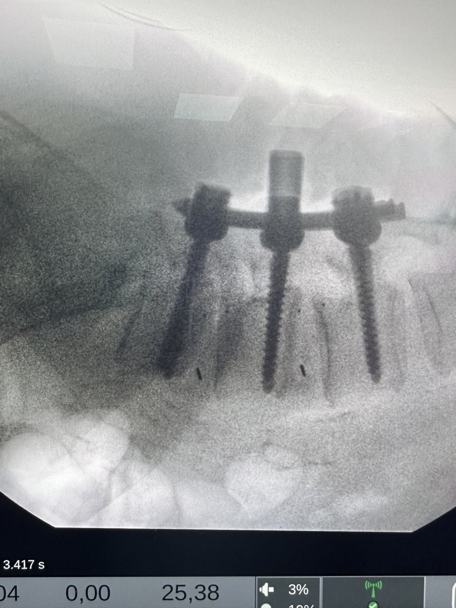 #العمر_مجرد_رقم

دكتور…هل عمليات العمود الفقري مفيدة لكبار السن؟!

هذا الشيخ ( الشاب )👇🏻

عمره ٨٠ سنة ( ماشاءالله)

كان يعاني من تزحزح فقري و ضغط شديد على الظفيرة العصبية

آلام شديدة أسفل الظهر و على الأقدام تمنعه من الوقوف و المشي

اليوم هذه حالته بعد ٢٤ ساعة من العملية❤️