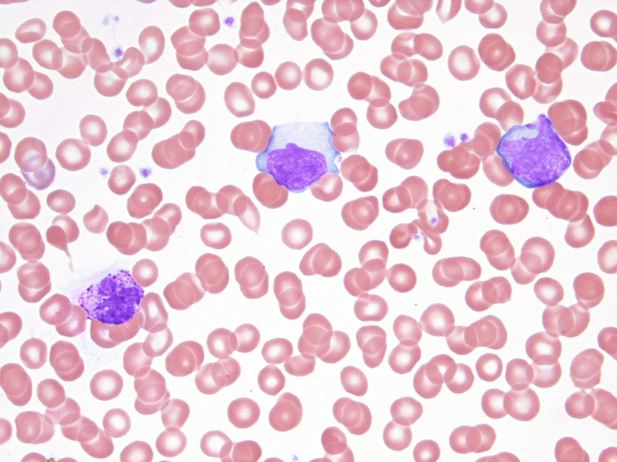hemepathguy's tweet photo. #hemepath Downey cells in acute infectious mononucleosis (e.g. acute EBV) https://t.co/RSTOxB2YYb