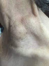 IhabFathiSulima's tweet photo. Postprandial pain and weight loss.
What is the aetiology of left side neck mass? https://t.co/PSc7GFqTsh