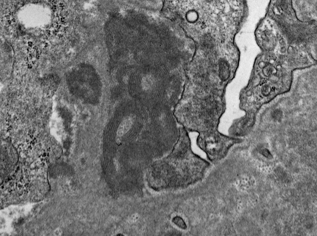 Touched by lupus... I know pathologists are constantly thinking about food, but is it just me or does anyone else think of pasta when you see these lupus "fingerprint" structures in deposits??  😄