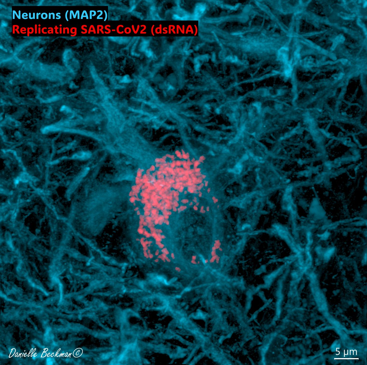 DaniBeckman's tweet image. Not 👏Brain 👏Fog👏
This is a photo of a neuron exploding with #SARSCoV2.
This is Brain Damage.