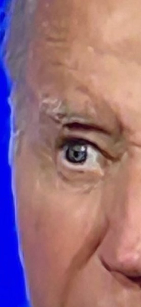 What is in his eye?