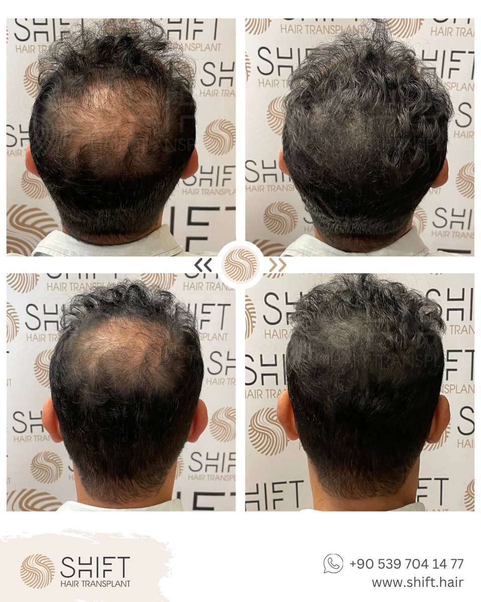 shifthairtr's tweet image. Experience the incredible results of scalp micropigmentation with SHIFT Hair in Istanbul! Our skilled expert uses this innovative technique to create the appearance of a fuller head of hair, transforming your look.

#ScalpMicropigmentation #Micropigmentation #SMP