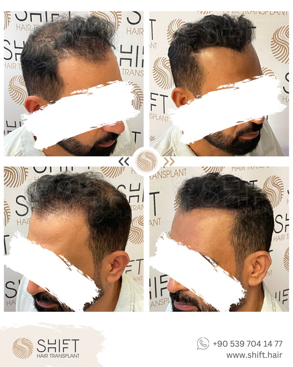 shifthairtr's tweet image. Experience the incredible results of scalp micropigmentation with SHIFT Hair in Istanbul! Our skilled expert uses this innovative technique to create the appearance of a fuller head of hair, transforming your look.

#ScalpMicropigmentation #Micropigmentation #SMP