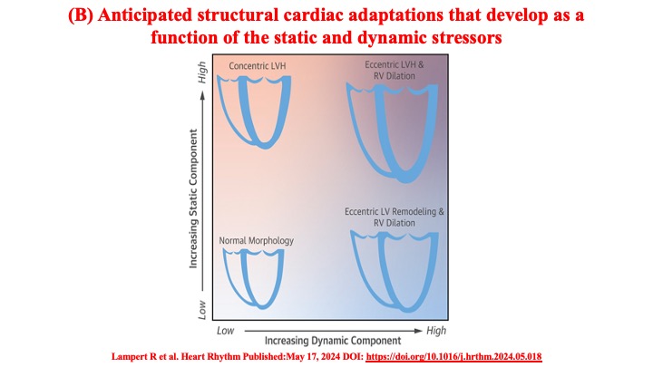 drraviele's tweet image. 📌 Figures illustrating
👉 Expected ventricular adaptation from 
✔️ static &amp;amp; dynamic stressors on the heart
#SportsCardiology #CardioTwitter #Eercise @DBelardoMD @DrMarthaGulati @SeguraCardio @SSharmacardio @DrRoderickTung @s_gati @DhirajGuptaBHRS  @LluisMont2 @MJAckermanMDPhD