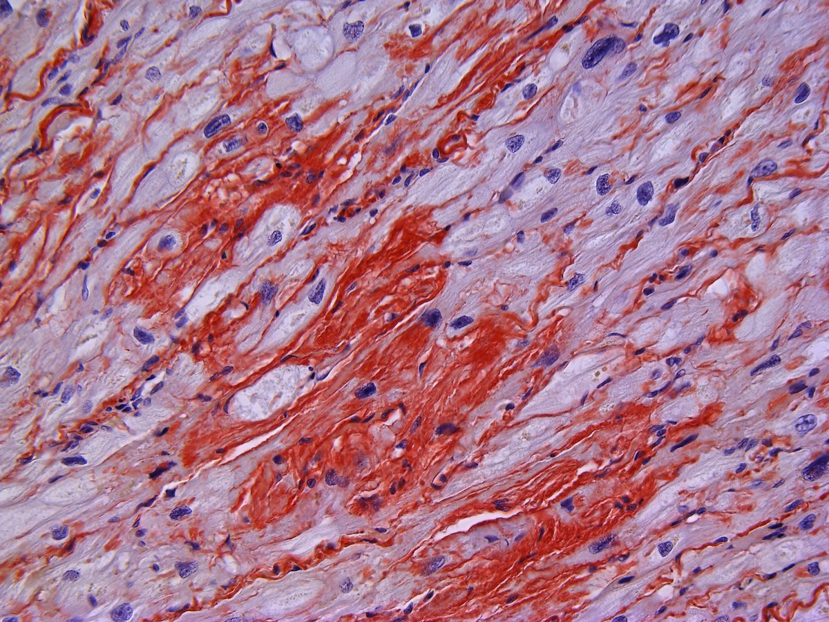 Pathology Walker@Auto Tweet Bot tweet media