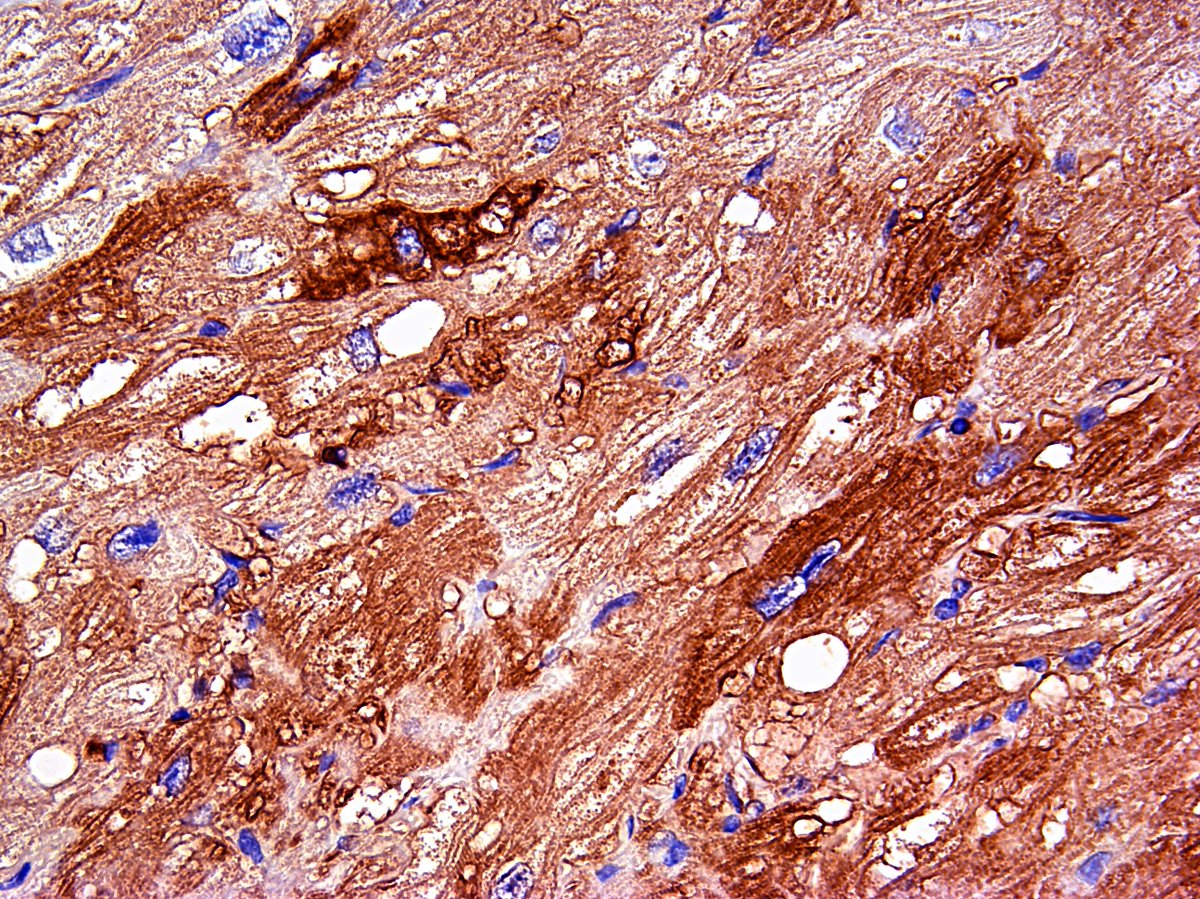 Pathology Walker@Auto Tweet Bot tweet media