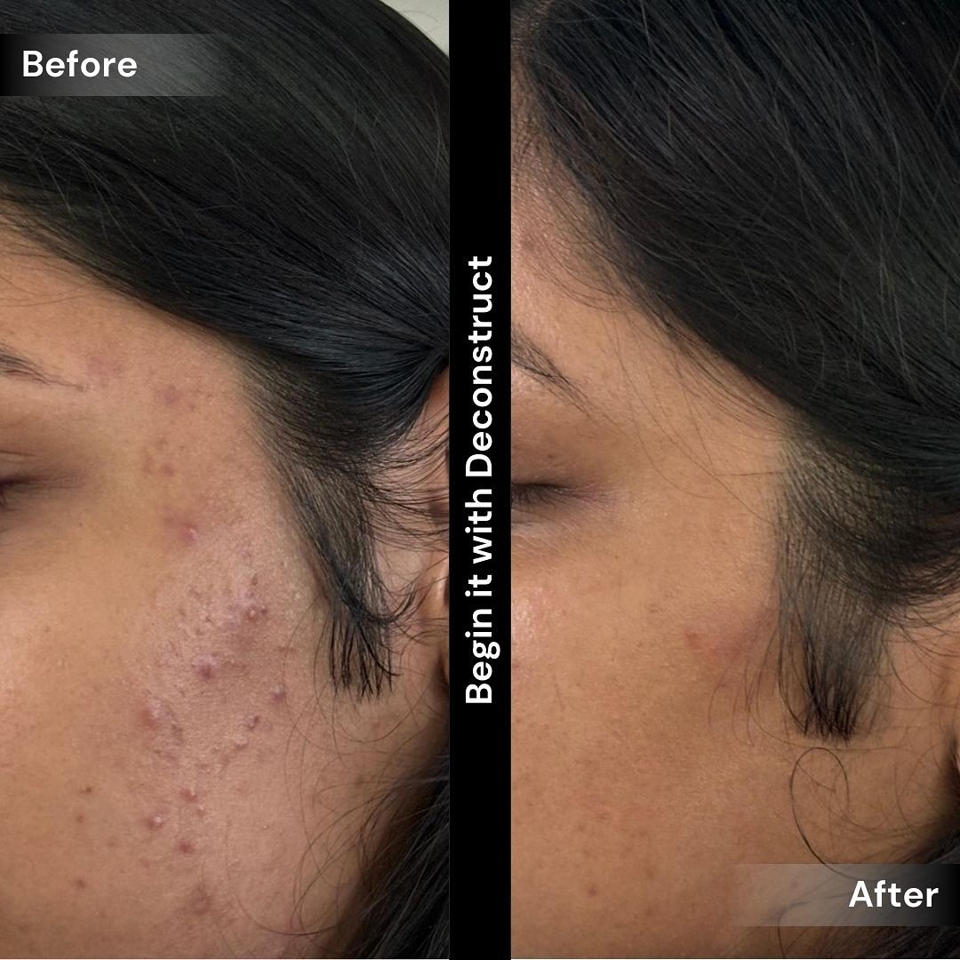 deconstructskin's tweet image. Struggling with acne, inflammation, or oily skin? 🌟 

Our breakout control serum is your ultimate solution! Say goodbye to breakouts and hello to clear, balanced skin.✨🤌✅🤩

#BreakoutControl #AcneSolution #ClearSkin #SkincareRoutine #InflammationRelief #OilFree #HealthySkin…