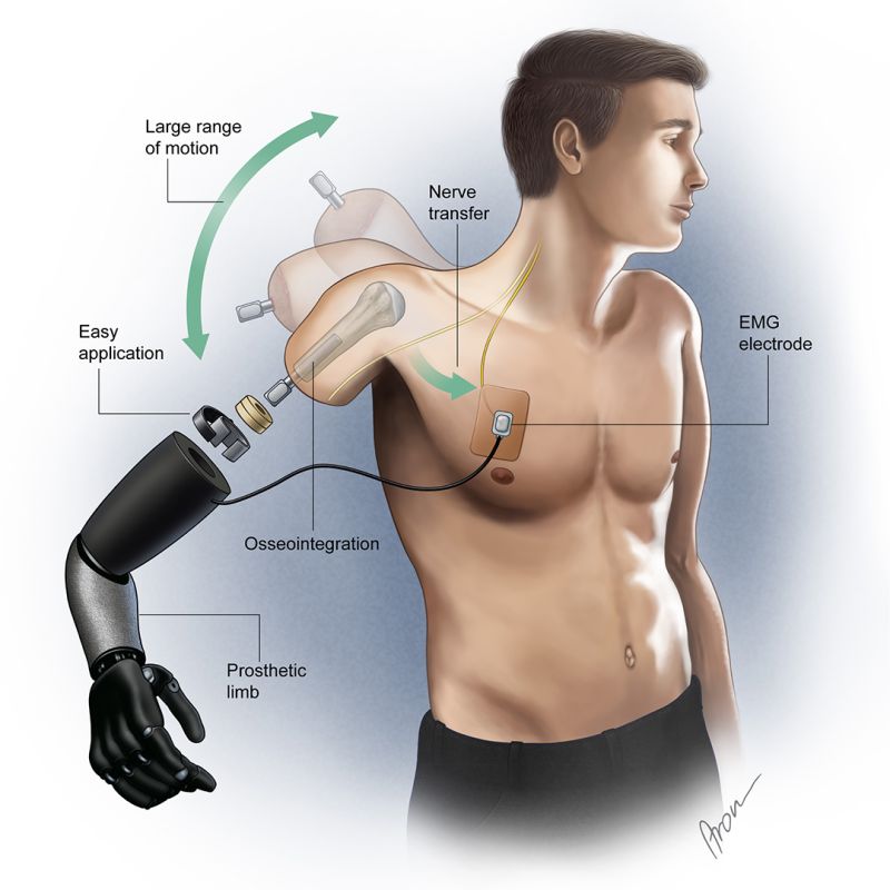 Integrum Osseointegration tweet media