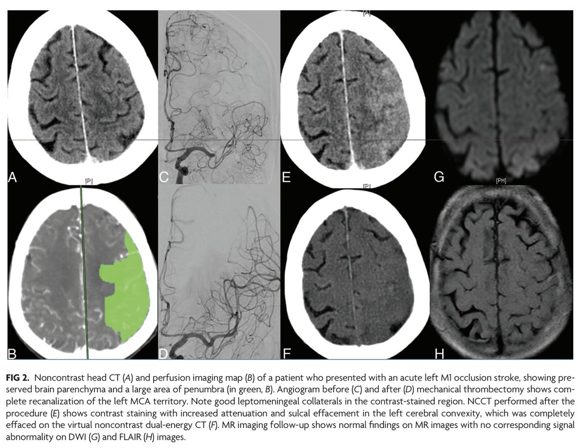 AJNR (@theajnr) on Twitter photo "Contrast Staining in Noninfarcted Tissue after Endovascular Treatment of Acute Ischemic Stroke"
doi.org/10.3174/ajnr.A…
#Stroke #FellowsJournalClub <a href="/AbdalkaderMD/">Mohamad AbdalKader</a>; <a href="/NguyenThanhMD/">Thanh Nguyen 🇺🇦</a> "Contrast Staining in Noninfarcted Tissue after Endovascular Treatment of Acute Ischemic Stroke"
doi.org/10.3174/ajnr.A…
#Stroke #FellowsJournalClub <a href="/AbdalkaderMD/">Mohamad AbdalKader</a>; <a href="/NguyenThanhMD/">Thanh Nguyen 🇺🇦</a>